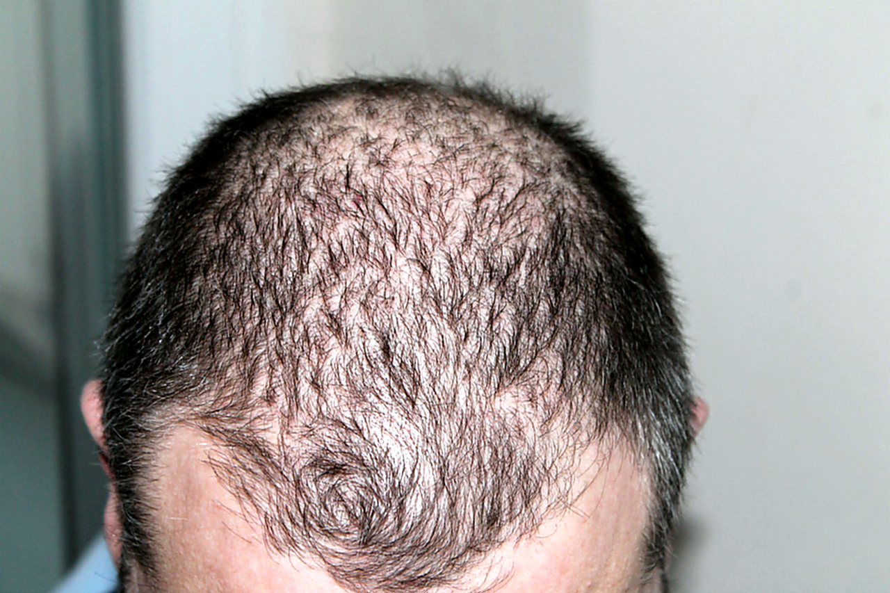 Ich habe erblich bedingten Haarausfall – Was kann ich tun?